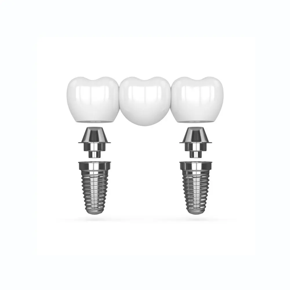dental implants - multi tooth implant bridge