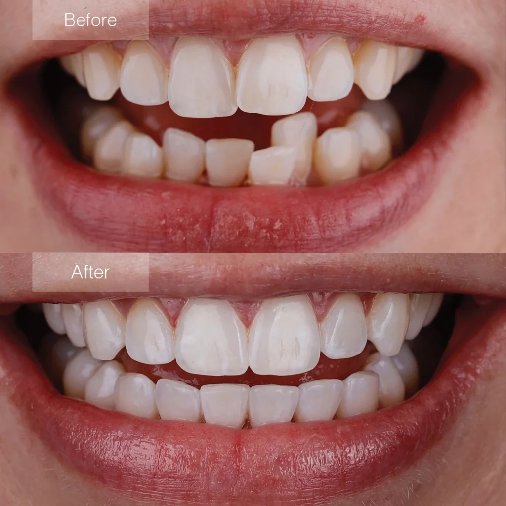 before and after Invisalign Laurel, MT