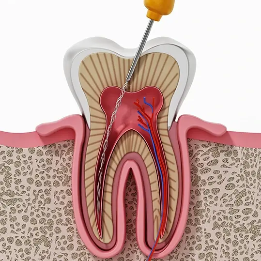 diagram of a root canal procedure